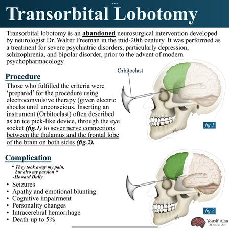Transorbital lobotomy